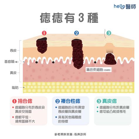 痣太多|痣變大、痣多或長毛會變皮膚癌？認識痣的形成與原因